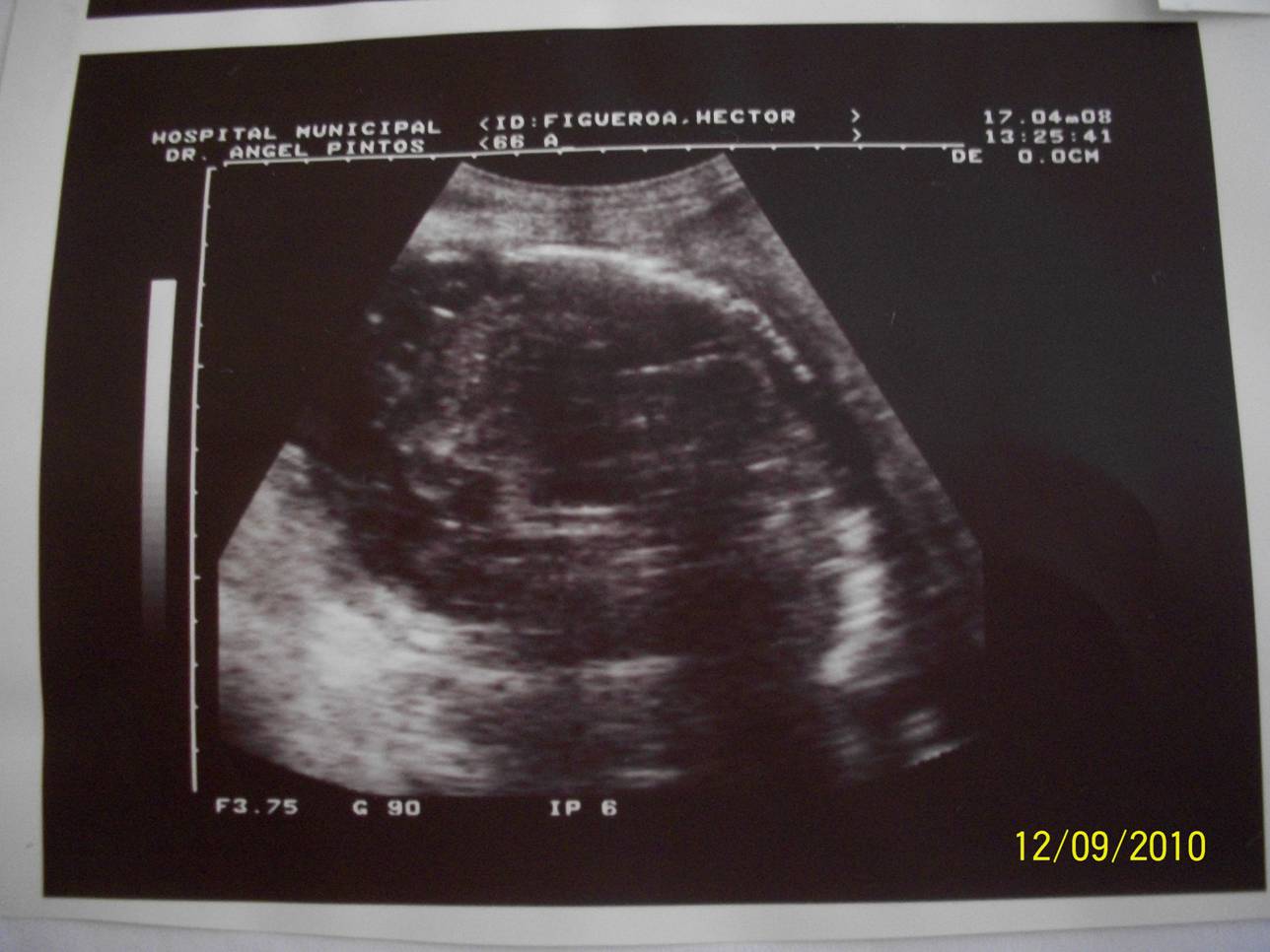 Quiste hepatico simple complicado