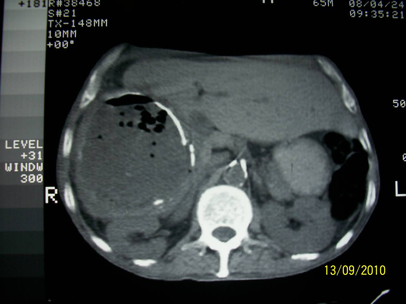 Complicado simple quiste hepatico