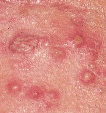 yeast infection treatments: Yeast infection causes and symptoms