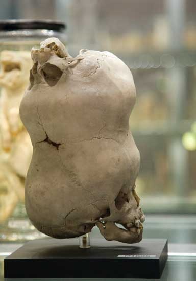 [Double+skull+of+child.jpg]