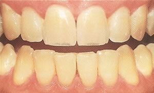 Pictures Of Teeth Stained From Coffee And Tea 62