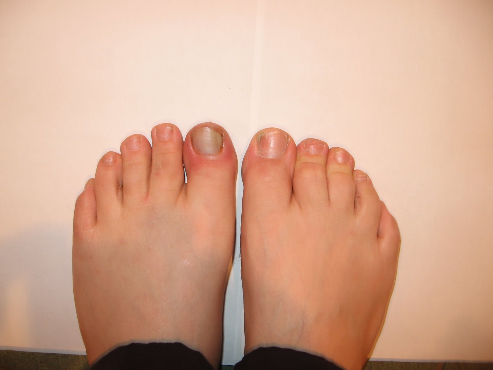Why Would Toenails Turn Blue at Keith Hickson blog