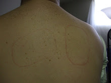 Kenny's burn marks on his back!