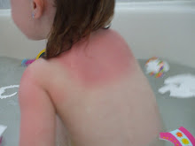 Brooke's first sunburn!