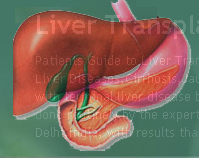 Liver Transplant In India Information Guide.