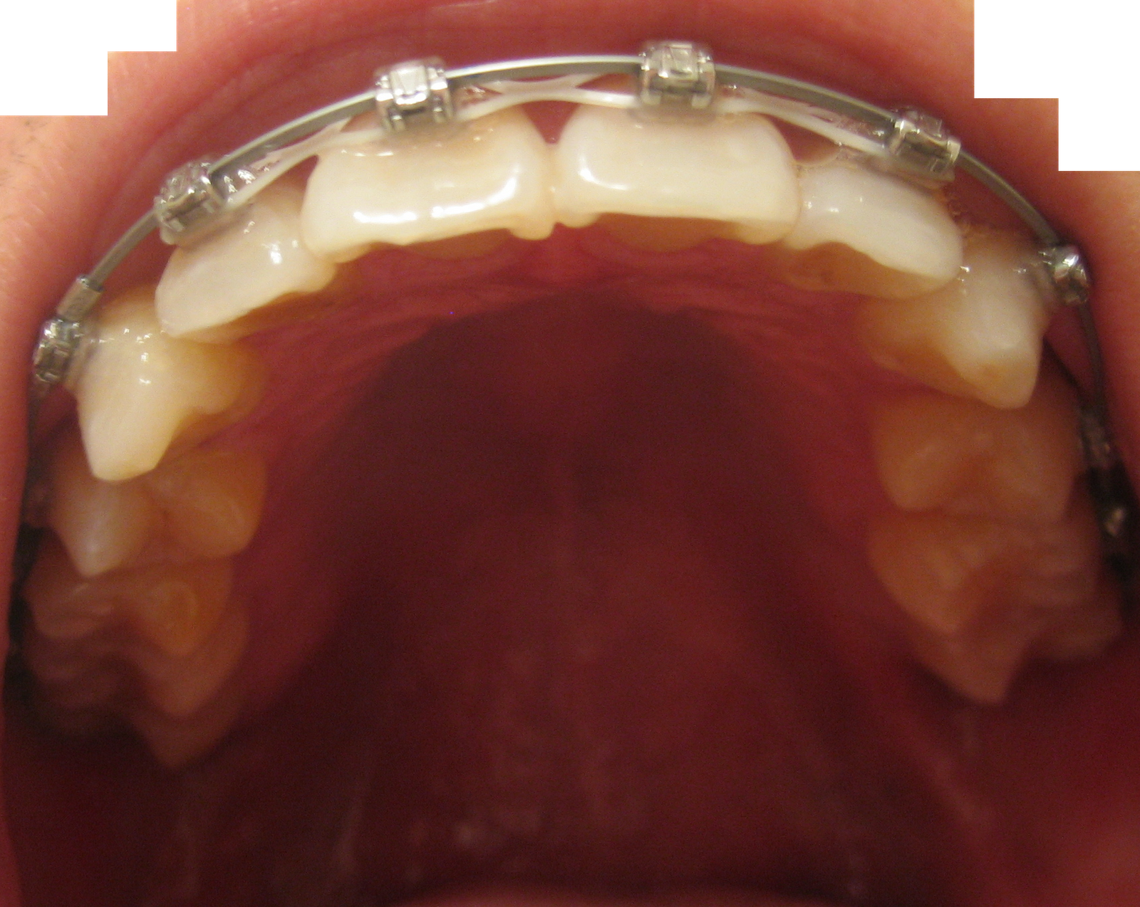 My Journey with the Damon Braces Week 33 Ortho Follow up & New wires