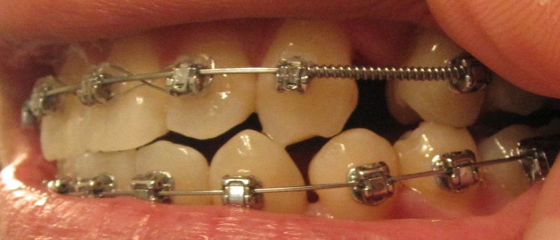 Tooth Braces and Pain Healthfully