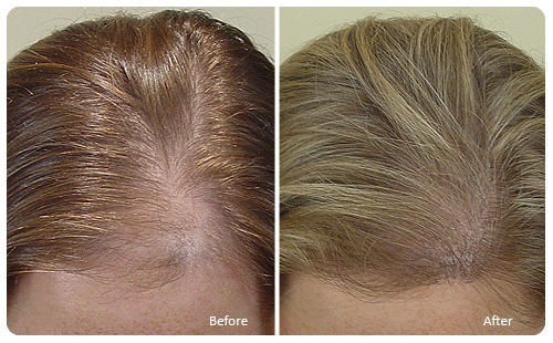 Kadınlarda saç dökülmesi