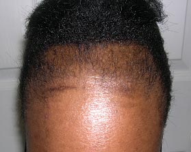 Traction Alopecia: The hairstyles which can cause hair ...