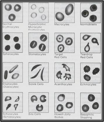 Resultado de imagen para anormalidades eritrocitarias