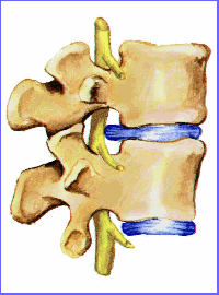 Off topic : Hernia discal L5-S1