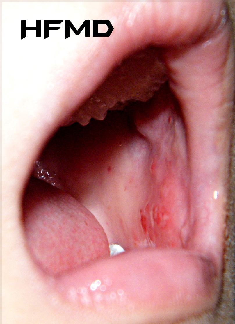 Water Blisters Mouth 92