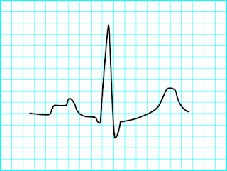 Kembara di bumi Malaysia: Interpreting Electrocardiogram (ECG) qrs complex diagram 