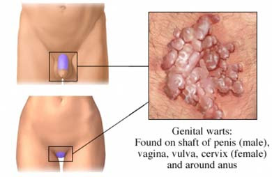 Cura virus papiloma humano en hombres