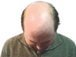 baldness.jpg