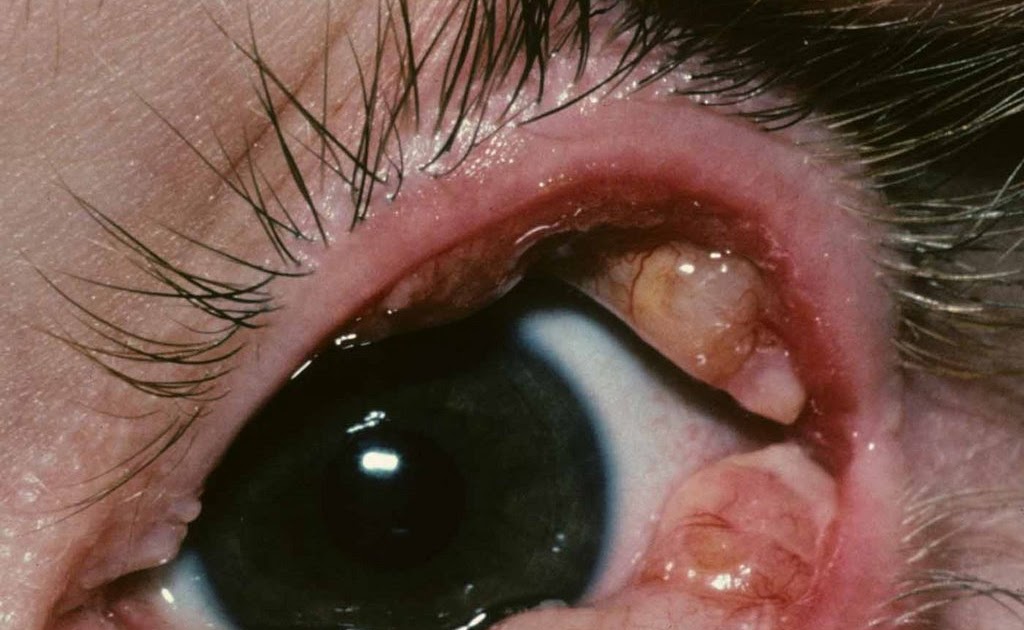 Olhos Vermelhos Em Fotos Pode Ser Doença - Sobre os Olhos