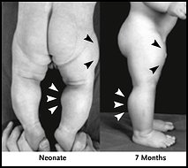 [myostatinblockedboy.jpg]