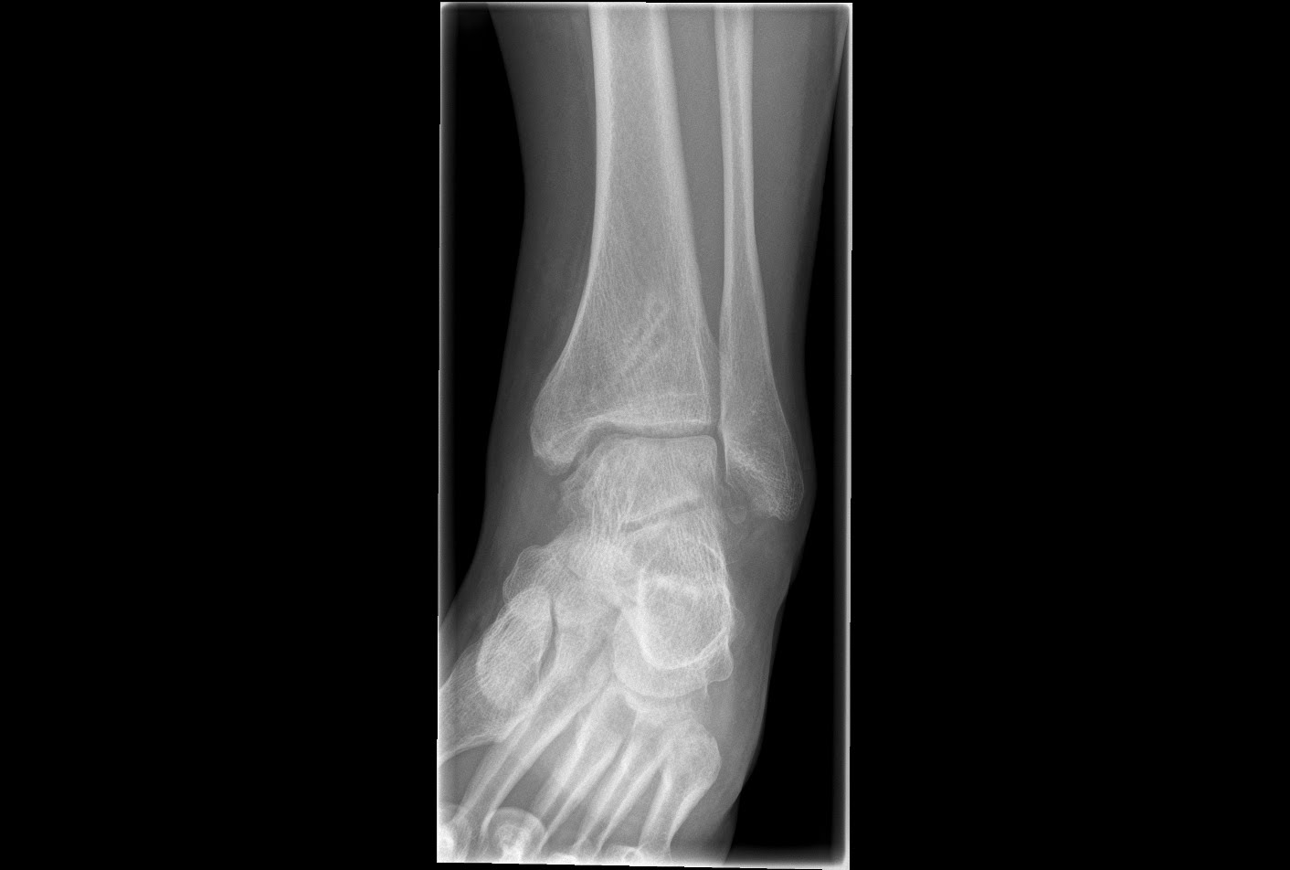 Sprunggelenksarthrose bei Osteochondrosis dissecans beider