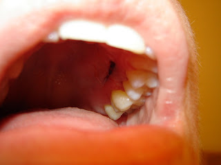 Numbness In Roof Of Mouth 59