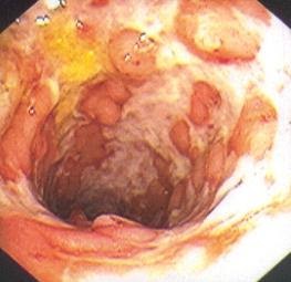 Colitis ulcerosa partnersuche