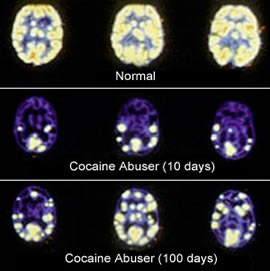 The Effects of Cocaine on the Brain
