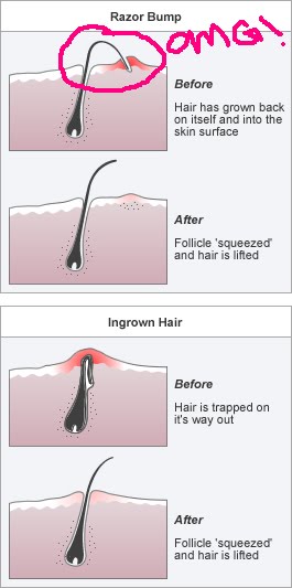 Jones Gallery Ingrown Hair Take Care Of This