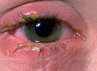 [conjuntivitisNTnva.jpg]