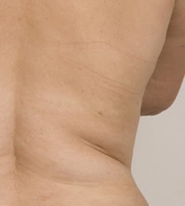 Estoy delgada pero tengo celulitis en el abdomen