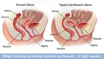 Tilted Uterus And Sex 3