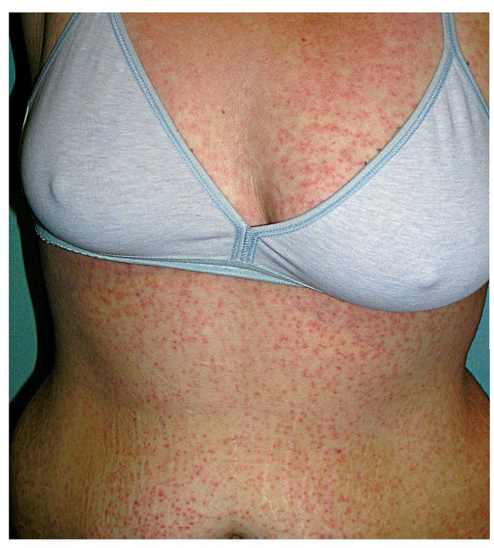 rash with mononucleosis #10