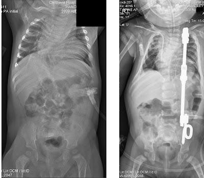 The Handleys!: What a difference VEPTR makes