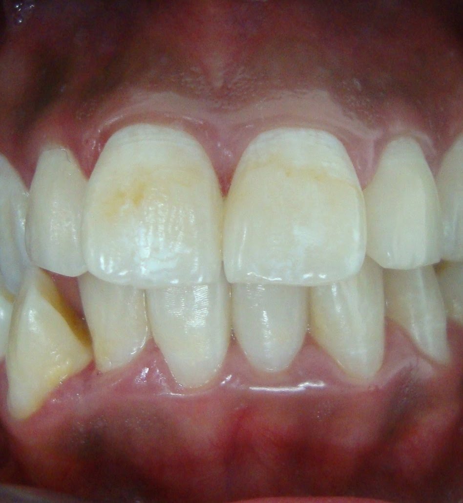 Odontología al Día MICROABRASIÓN DEL ESMALTE