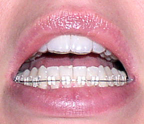 Power Chain Invisalign Was OrthoClear, Now Invisalign: Power chain!