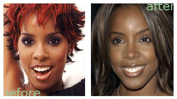 Kelly Rowland Nose Job - Plastic Surgey Before and After