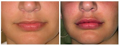 Lip Augmentation Before And After