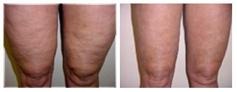 Mesotherapy Results