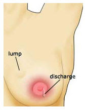 Lump In Breast