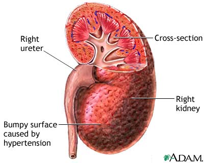 [hypertensive-kidney.jpg]