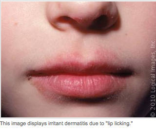Best Natural Cure For Severely Chapped Lips Best Natural Cure For Severely Chapped Lips