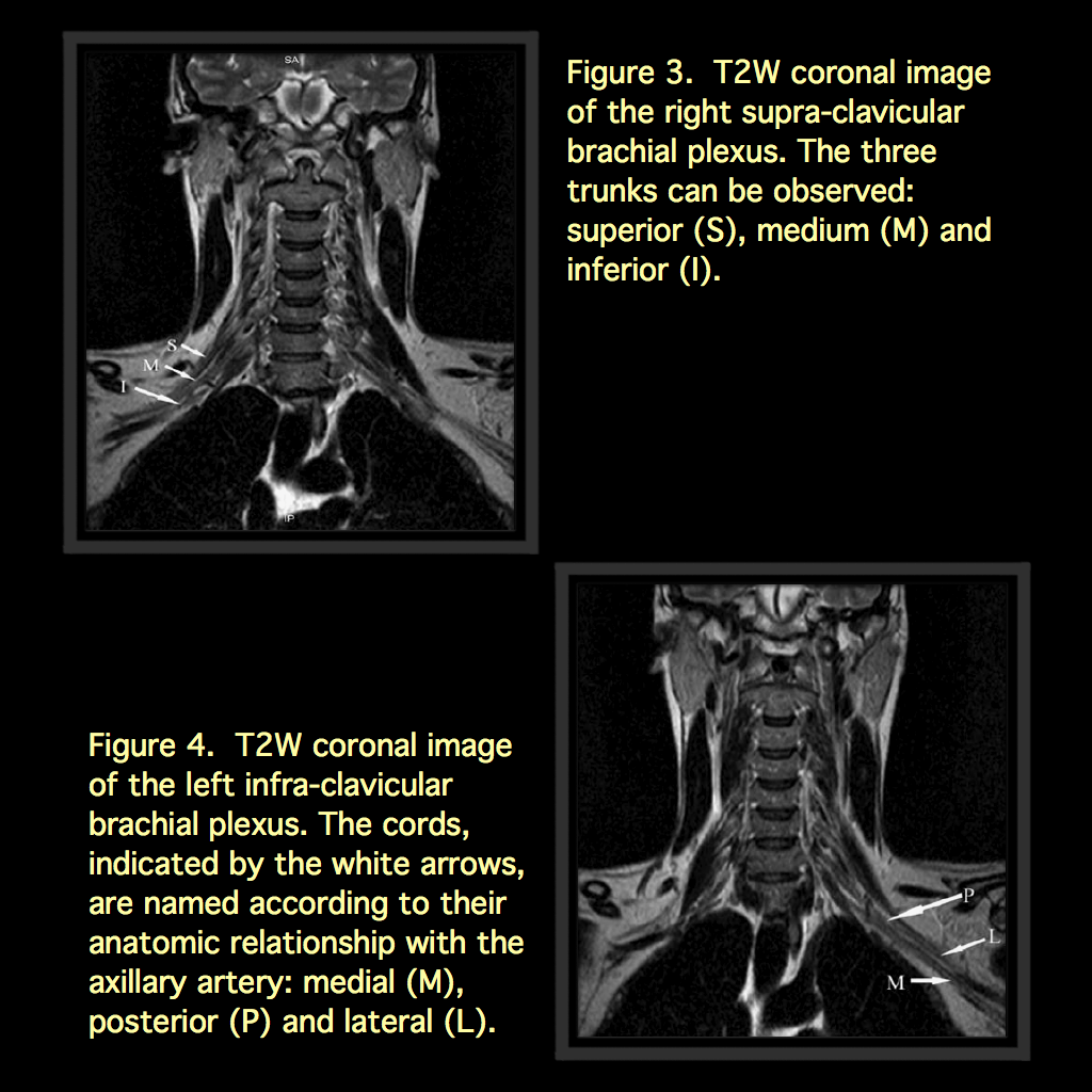 MRI BLOG Brachial Plexus MRI (I/II)