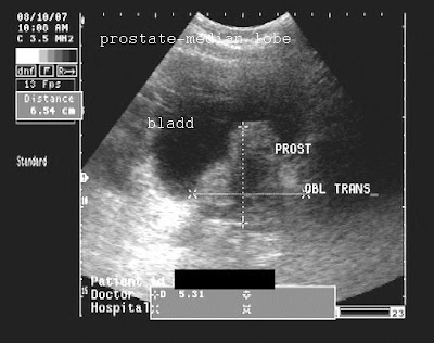 ON - RADIOLOGY: Ultrasound images of Benign prostatic hyperplasia