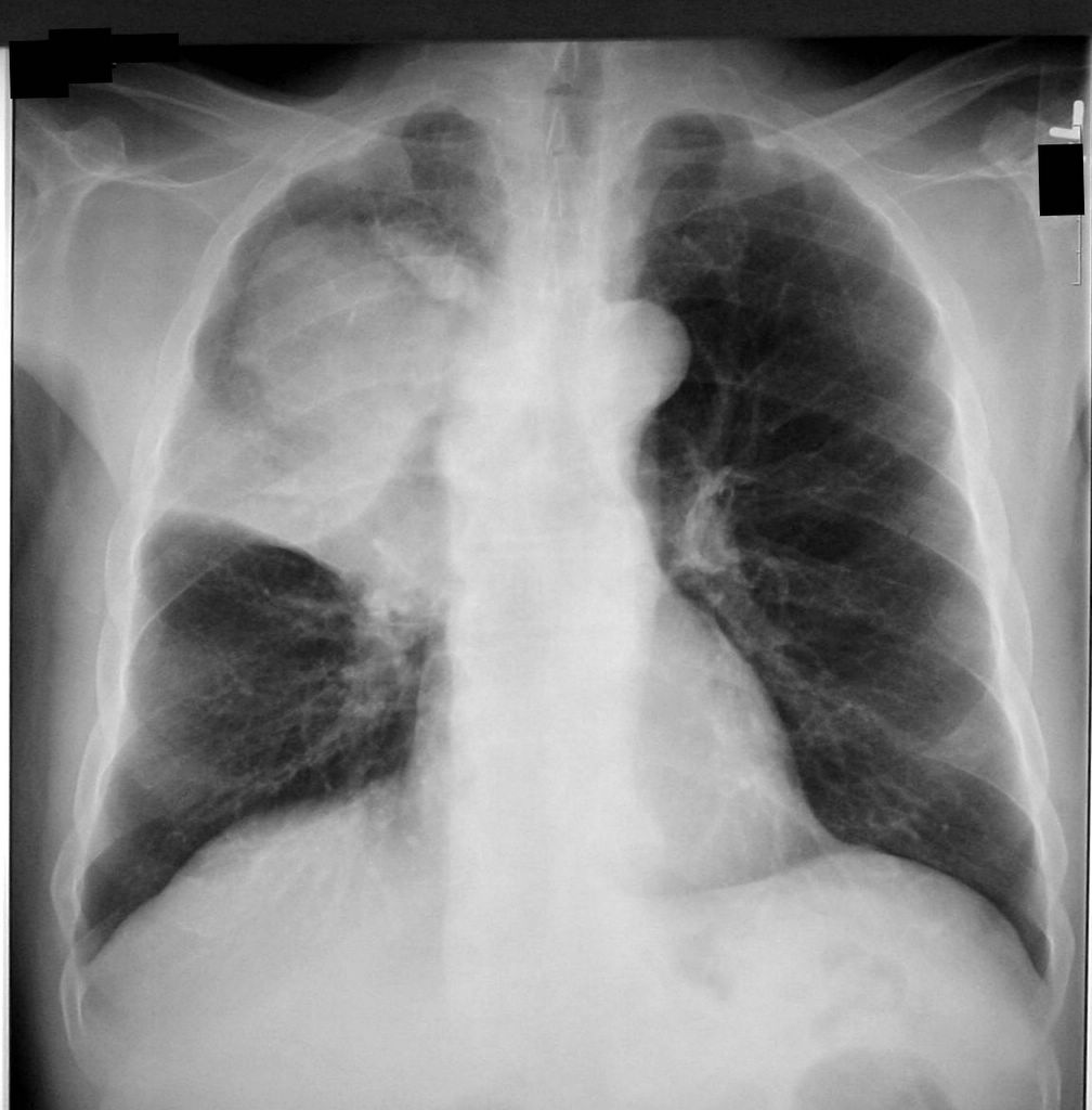 doctors-gates-job-hazards-in-lung-cancer