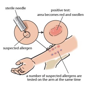 Skin Prick Tests for Food Allergies - Food Allergy ...