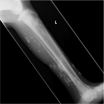 Doctors Gates: About Dermatomyositis