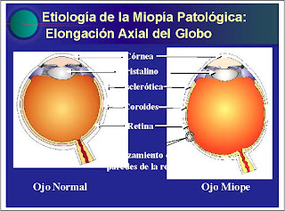 retina miopia magna)