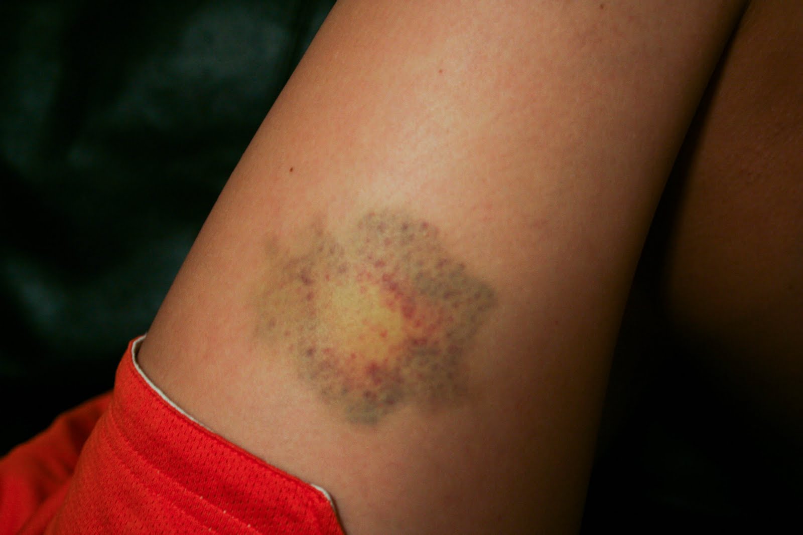how long to ice a bruise how long to ice a bruise