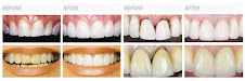 Cosmetic Dentistry (Jacket Bridge Porcelain)