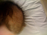 Female-Hair-Loss