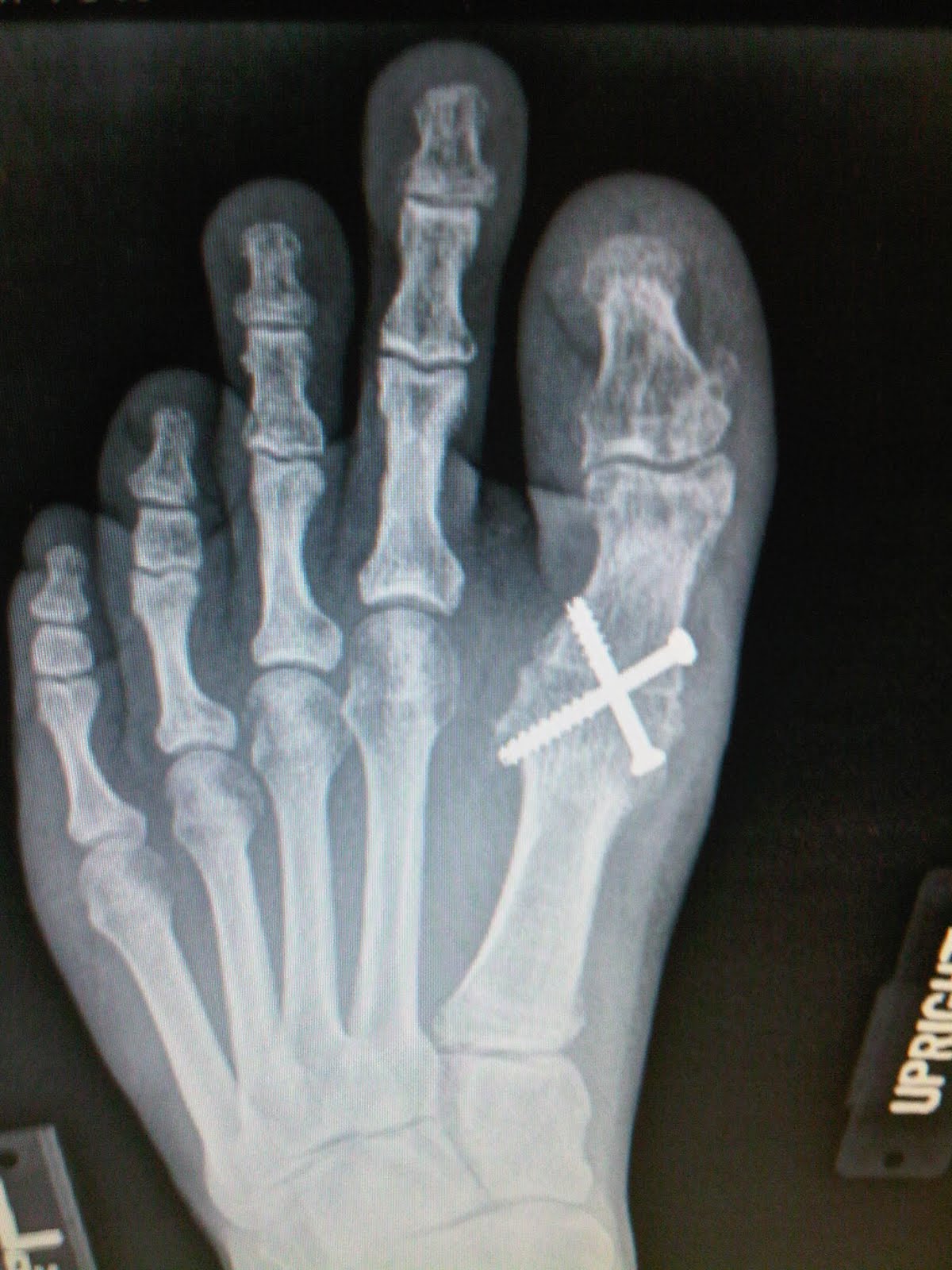 Journey Big Toe FusionLive Surgery Results