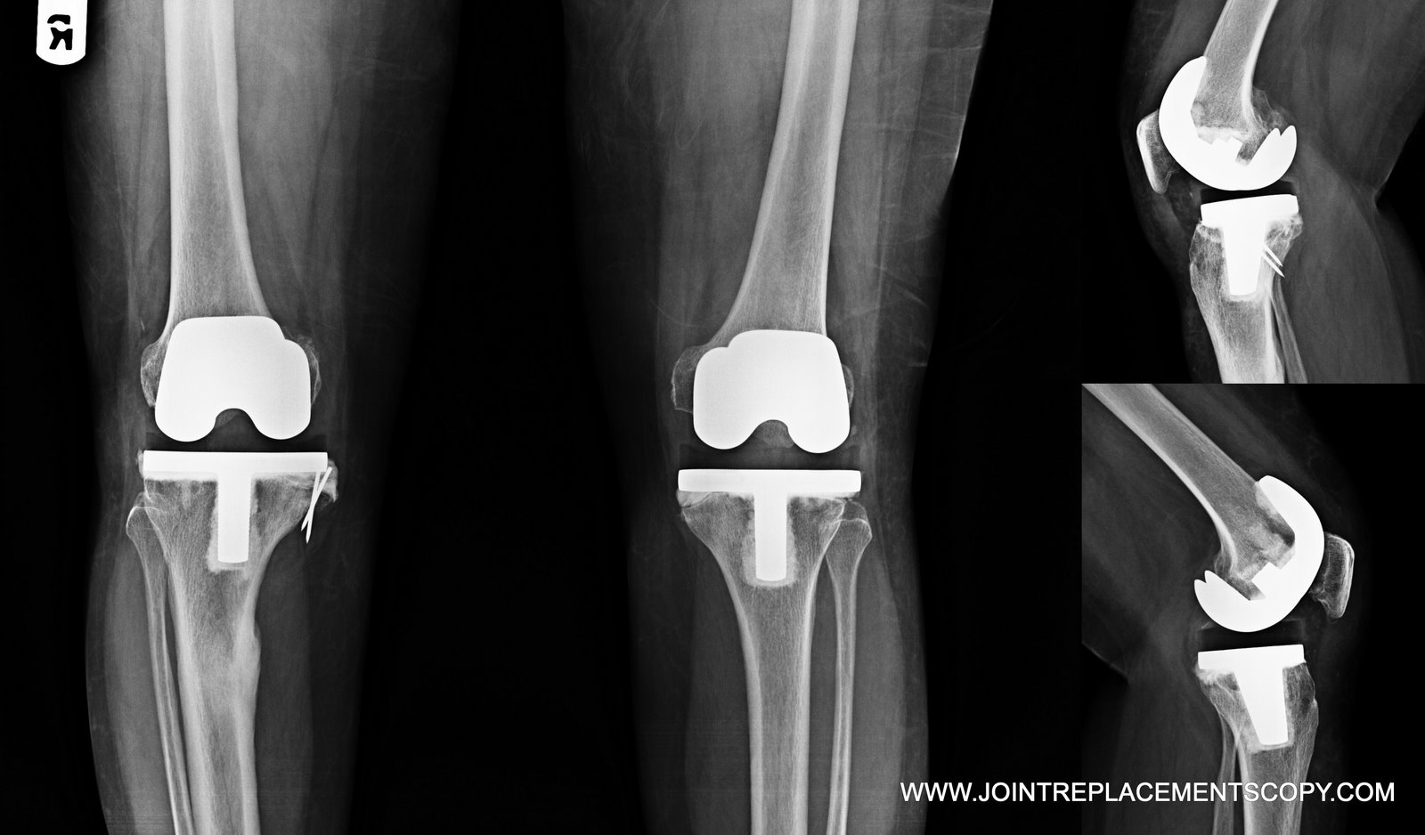 Jointreplacementscopy Knee joint replacement